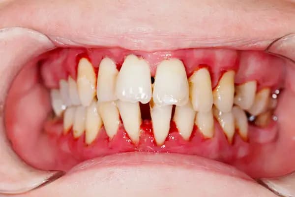gumsurgeryimage